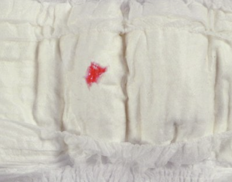 False menstruation in nappy