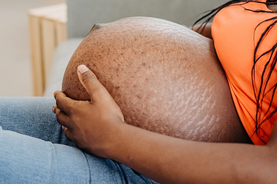 Stretch marks on black skin