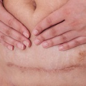 c-section scar